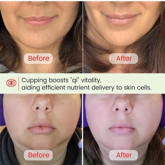 Facial Cupping Set & Gua Sha Facial Tool - Picture 4 of 6